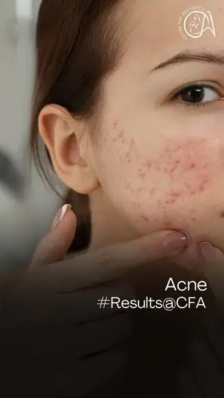 Acne Treatment in Gurgaon | Real Results with Dr. Akanksha Agarwal at Centre for Aesthetics 