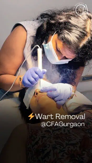 Wart Removal ⚡ Doctor-Led Session | Centre for Aesthetics, Gurgaon